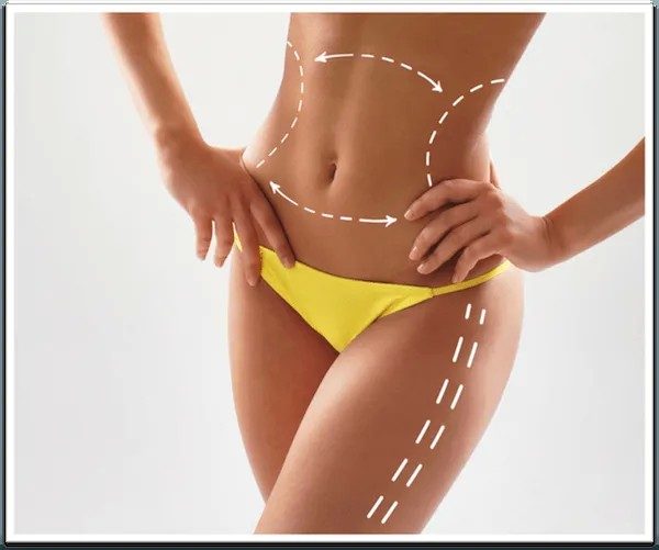 Liposuction vs. Waist Training