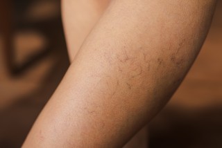 Erase Spider Veins with Visual Sclerotherapy: A Simple Solution for Clearer Skin