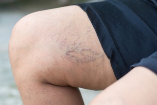 Prevention is Key! Tips for Avoiding Spider Veins and Varicose Veins